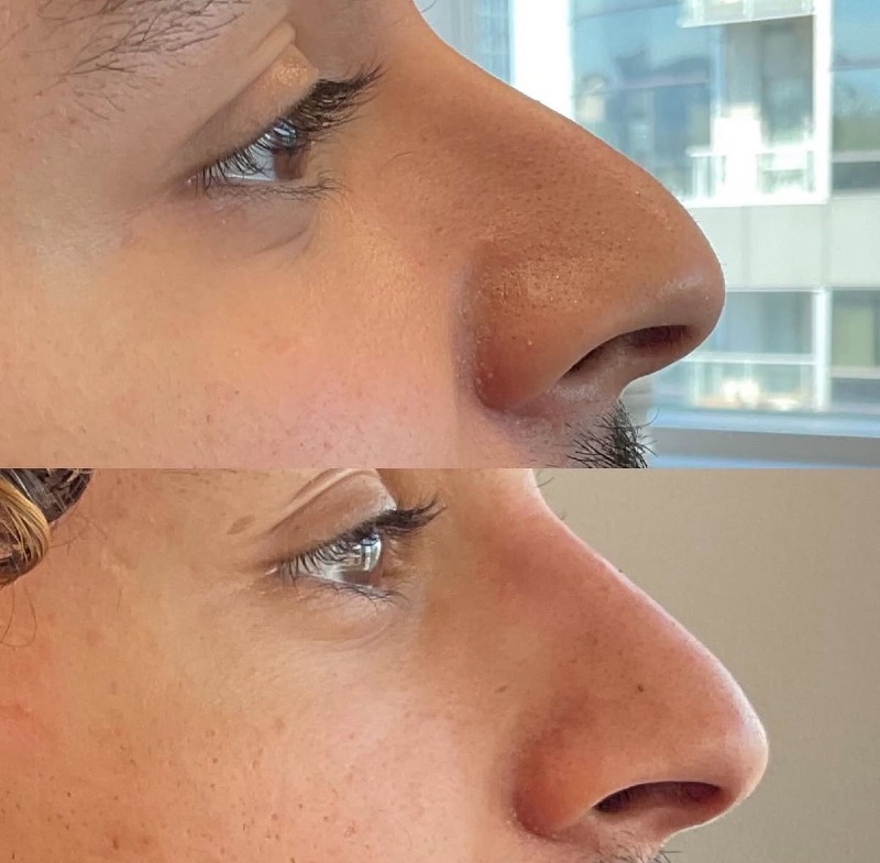 Rhinoplastie non chirurgicale