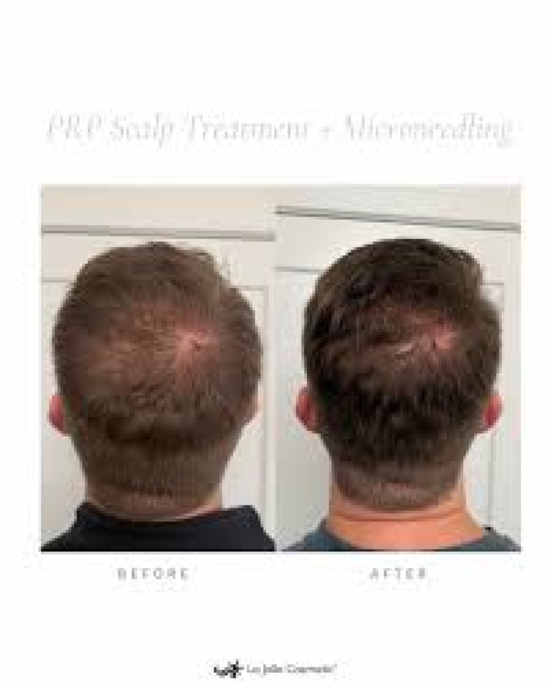 PRP / Microneedling cuir chevelu
