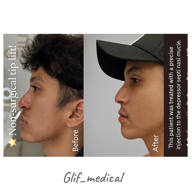 Rhinoplastie non chirurgicale