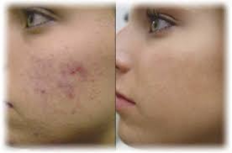 Traitement laser de l'acné